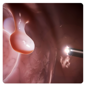 colonoscopy example